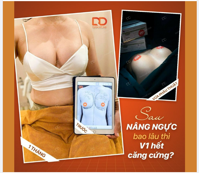 SAU NÂNG NGỰC BAO LÂU THÌ V1 HẾT CĂNG CỨNG?