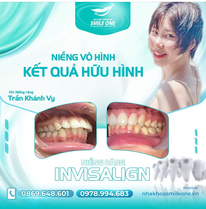 Bí quyết để có nụ cười tỏa sáng của Khánh Vy là gì