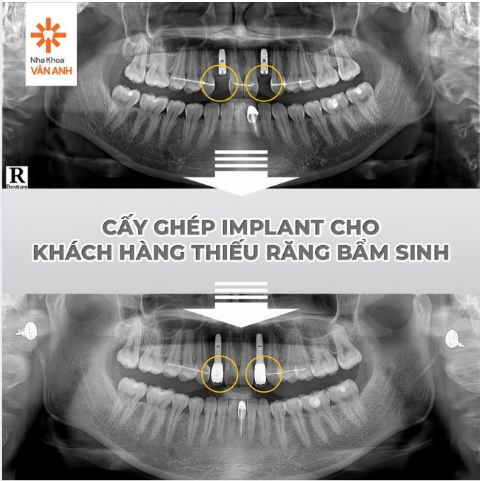 ĐÂU LÀ GIẢI PHÁP CHO THIẾU RĂNG BẨM SINH?