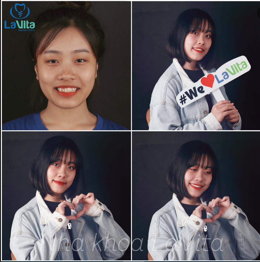 NIỀNG RĂNG MANG LẠI CHO BẠN NHIỀU LỢI ÍCH HƠN LÀ MỘT NỤ CƯỜI