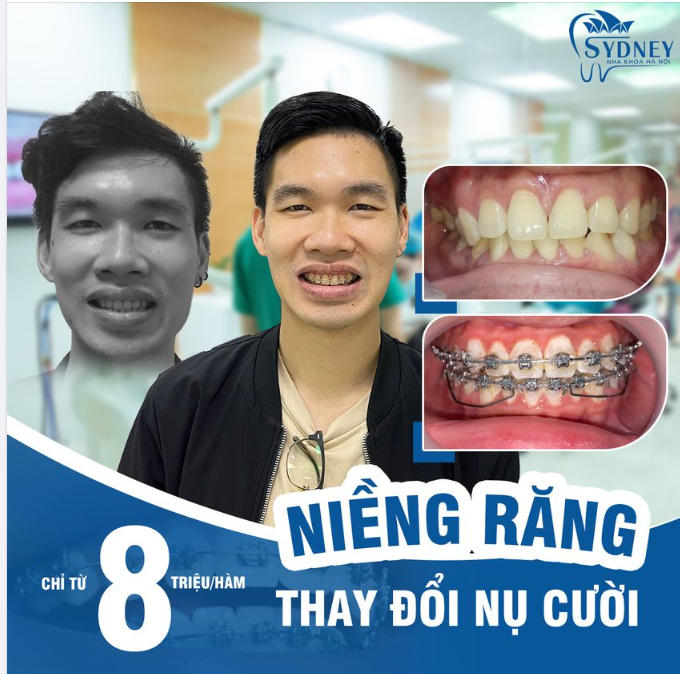 Niềng răng mắc cài kim loại – chi phí thấp, hiệu quả cao