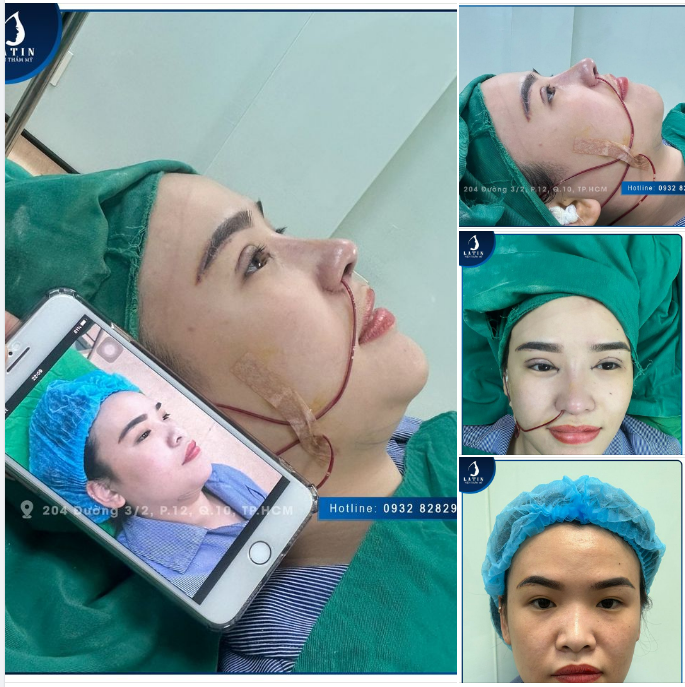 Hô biến nhan sắc cho chị khách hàng Việt kiều Mỹ