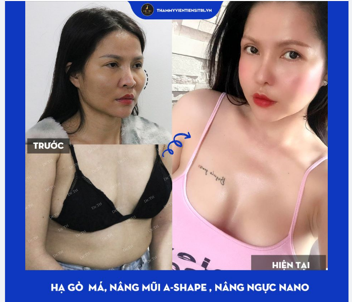 HẠ GÒ MÁ XONG CÓ BỊ HÓP MẶT KHÔNG?