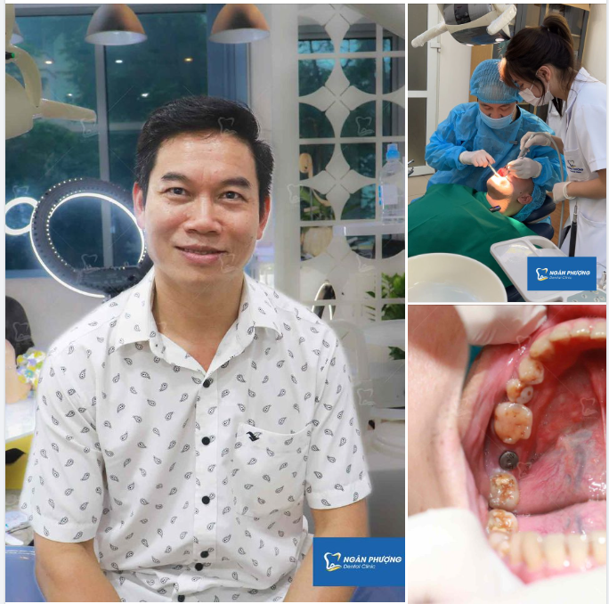 Ca implant cuối ngày cho anh Nguyễn Cường
