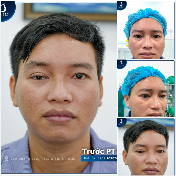 Phẫu thuật thành công chỉnh nhược cơ mí mắt cho khách hàng