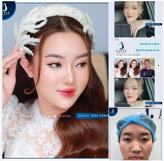 Feedback: Mũi bán cấu trúc 6 tháng SIÊU NÉT