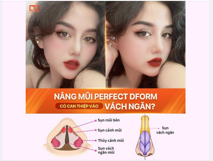Nâng mũi Perfect Dform có can thiệp vào vách ngăn?