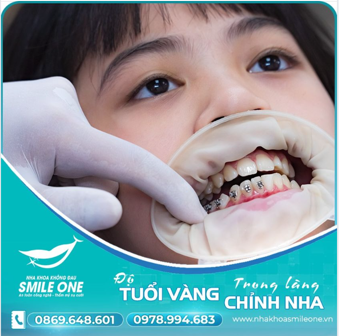 80% trong chúng ta bỏ lỡ giai đoạn tốt nhất để niềng răng của chính mình!