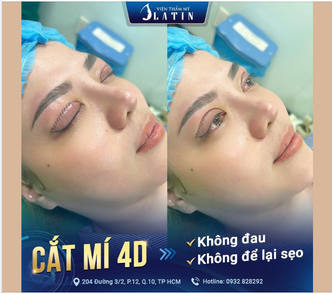 Mắt đẹp đón Lễ - Kết quả "SIÊU XINH" ngay sau CẮT MÍ 4D tại Latin