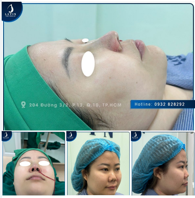 Khắc phục thành công tình trạng mũi thấp tẹt, đầu mũi hếch, cánh mũi to bè