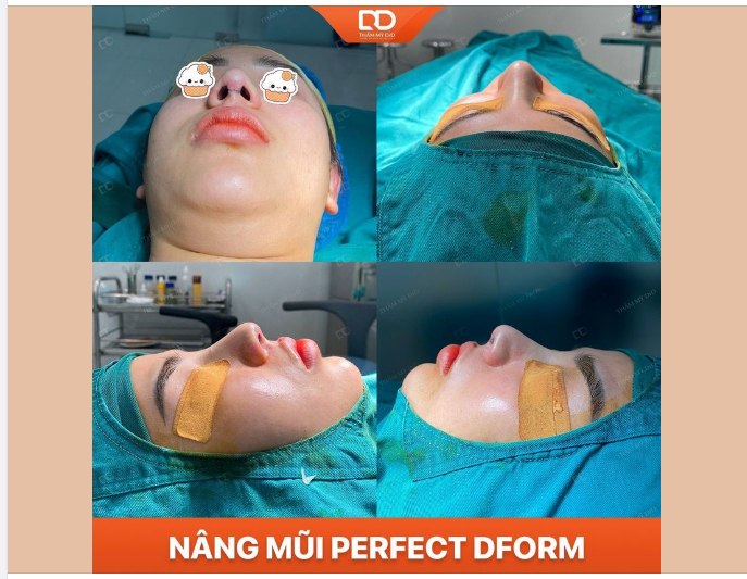 ĐẸP MỌI GÓC NHÌN SAU PHẪU THUẬT NÂNG MŨI PERFECT DFORM