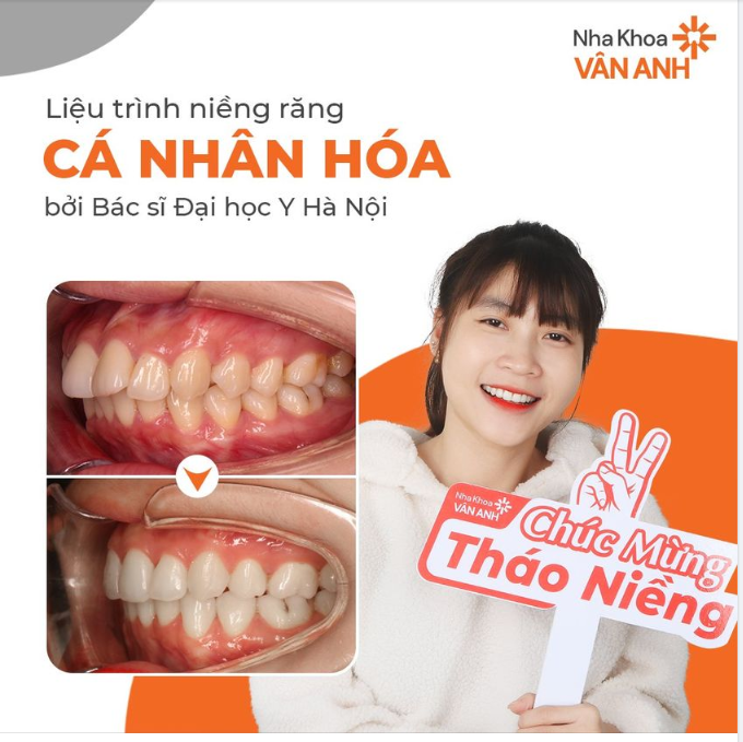 " Mình thấy tự tin rất nhiều từ khi niềng răng"