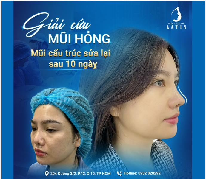 Chủ đề: SỬA MŨI HỎNG ĐÃ LÀM TẠI NƠI KHÁC