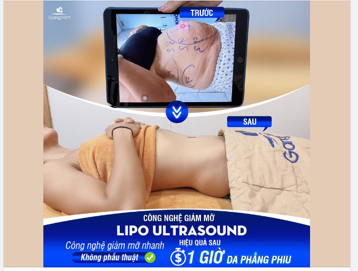 LIPO ULTRASOUND - HÚT MỠ KHÔNG ĐAU, BỤNG PHẲNG EO THON CHỈ SAU 60 PHÚT
