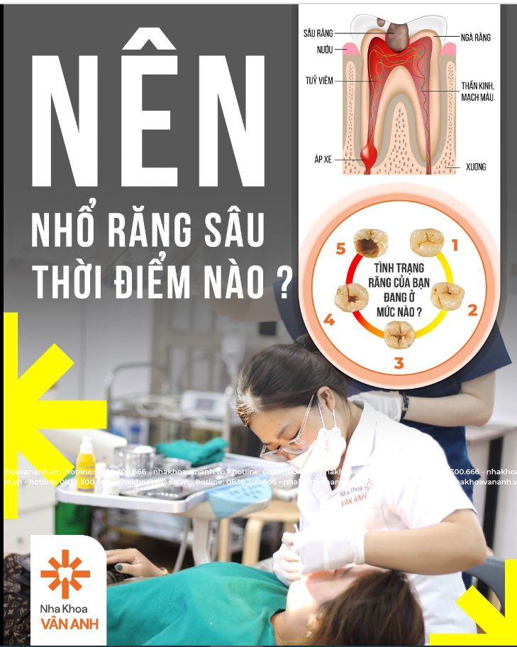 Thời điểm nào thích hợp để nhổ răng sâu?