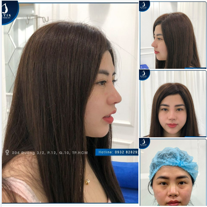 Quá xuất sắc với kết quả nâng mũi chỉ sau 11 ngày!