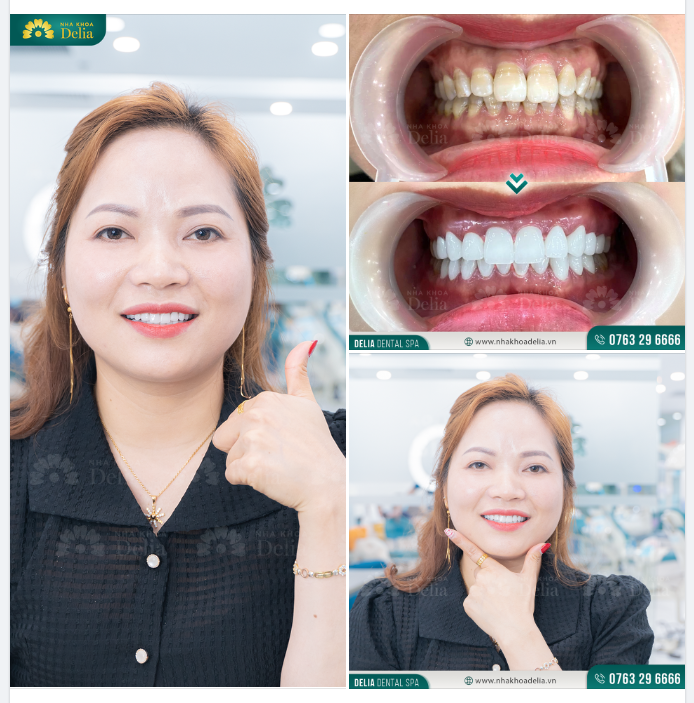 Thẩm mỹ 20 răng sứ Ceramill - Kiến tạo nụ cười trọn vẹn cho chị Lê Quỳnh