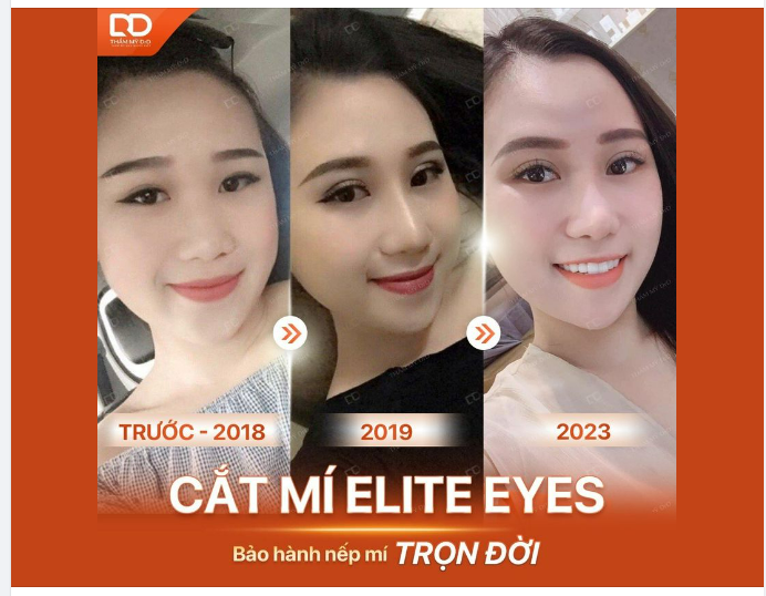 CẮT MÍ: Không đau, không lệch, kết quả như ý...
