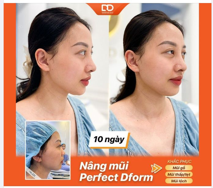 MŨI SAU 10 NGÀY ĐÃ HẾT SƯNG NỀ HOÀN TOÀN CHƯA?