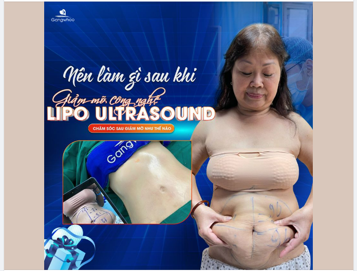 THỰC HIỆN GIẢM MỠ BỤNG XONG - LÀM GÌ VÀ KIÊNG GÌ?