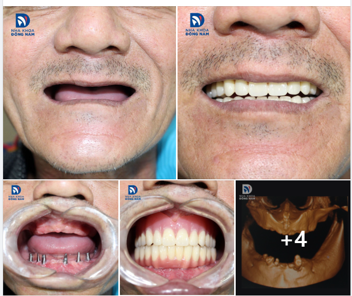 CASE THỰC TẾ 13 - CẤY 6 TRỤ IMPLANT CHO BỆNH NHÂN U70