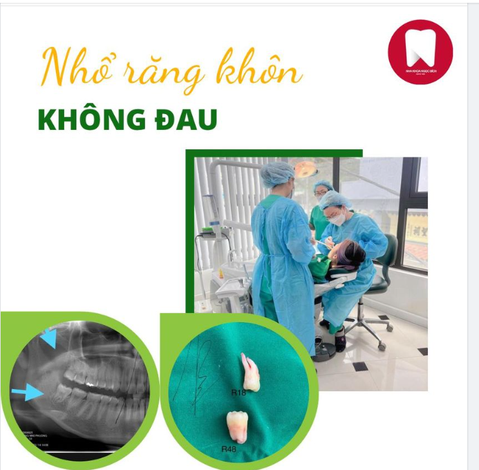 Chỉ 15p bạn đã có thể nhổ bỏ ​​​​​​​ khôn nhẹ nhàng