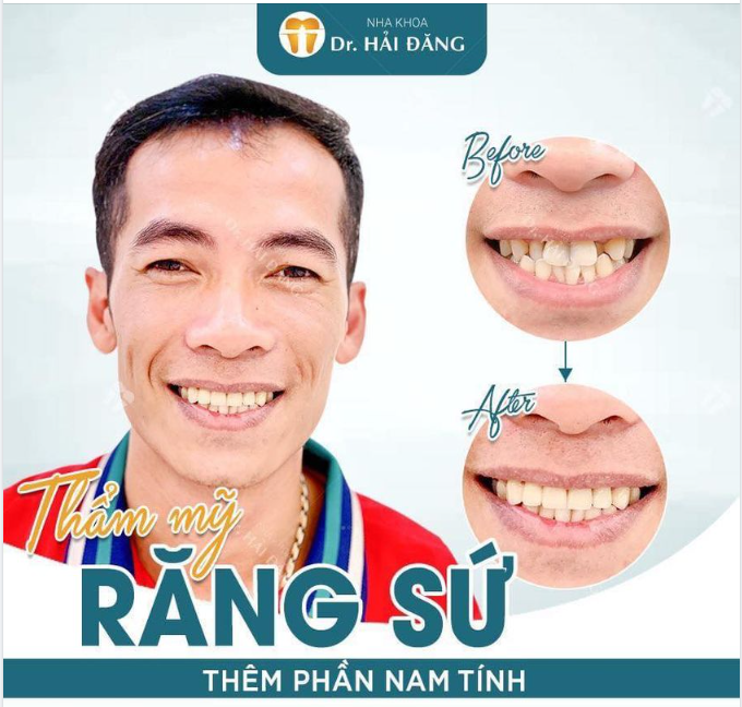 THẨM MỸ RĂNG SỨ CHO PHÁI NAM