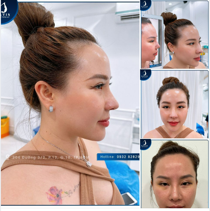 Kết quả nâng mũi, độn cằm tại Latin