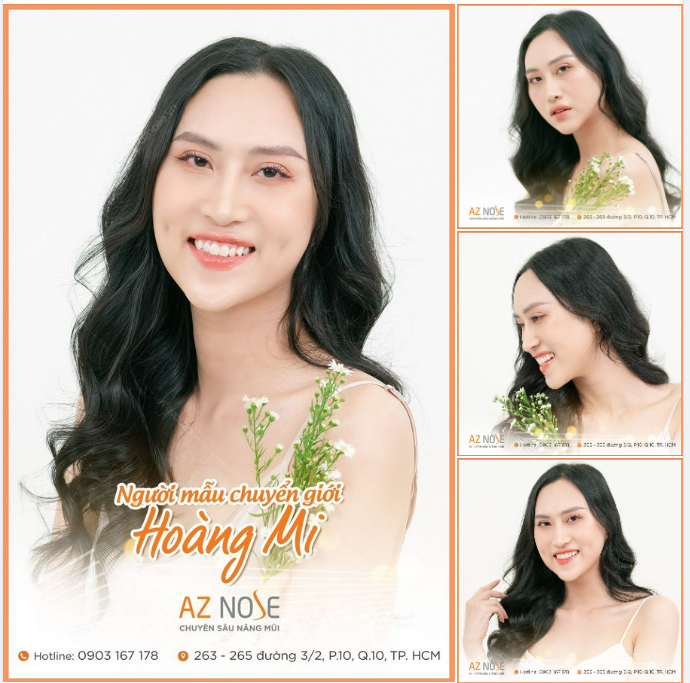Người mẫu chuyển giới Hoàng Mi từng nâng mũi 2 lần ở nơi khác nhưng gặp tình trạng sóng mũi .ao thô và lộ sụn. Vì vậy, Bác sĩ CKI. Nguyễn Hoàng Nam tư vấn thực hiện: