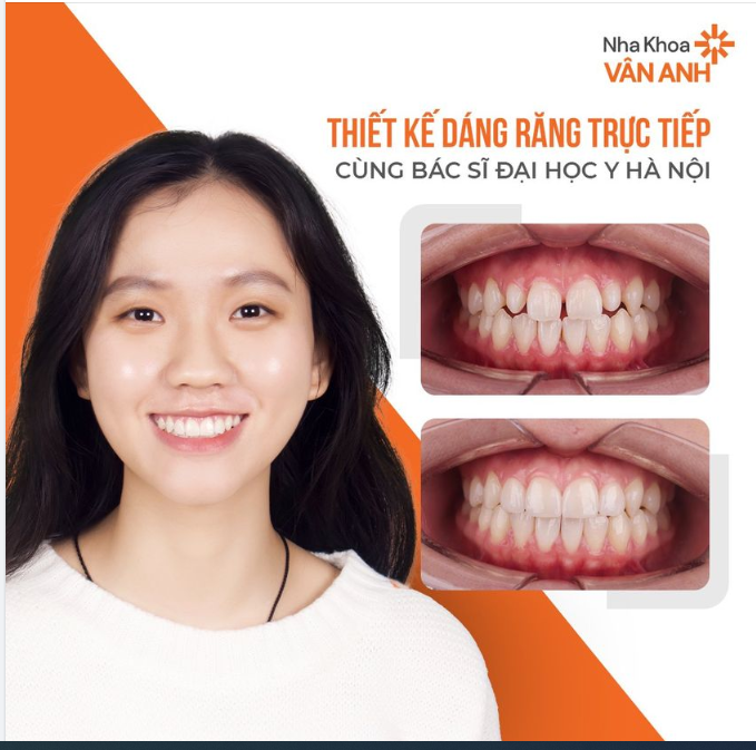 DÁN SỨ VENEER – RĂNG THƯA CHỈ CÒN LÀ CHUYỆN NHỎ