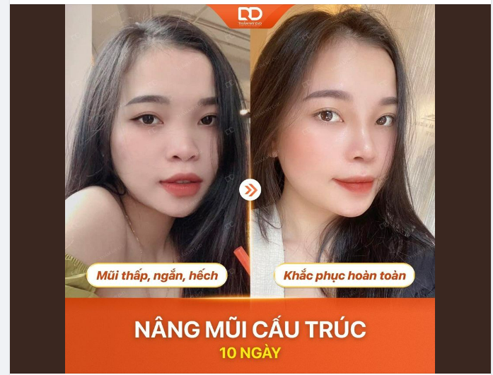 NÂNG MŨI CẤU TRÚC KHẮC PHỤC MỌI KHUYẾT ĐIỂM KHẮC PHỤC HOÀN TOÀN KHUYẾT ĐIỂM