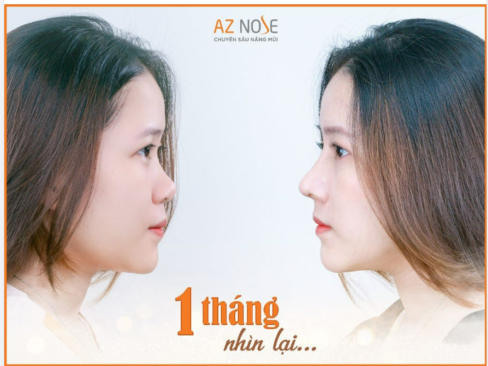 Chị Q.N (Đồng Nai) chia sẻ sau khi nâng mũi.