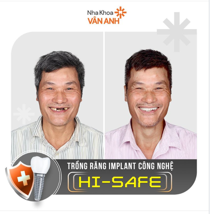 Càng lớn tuổi càng phải trồng Implant sớm