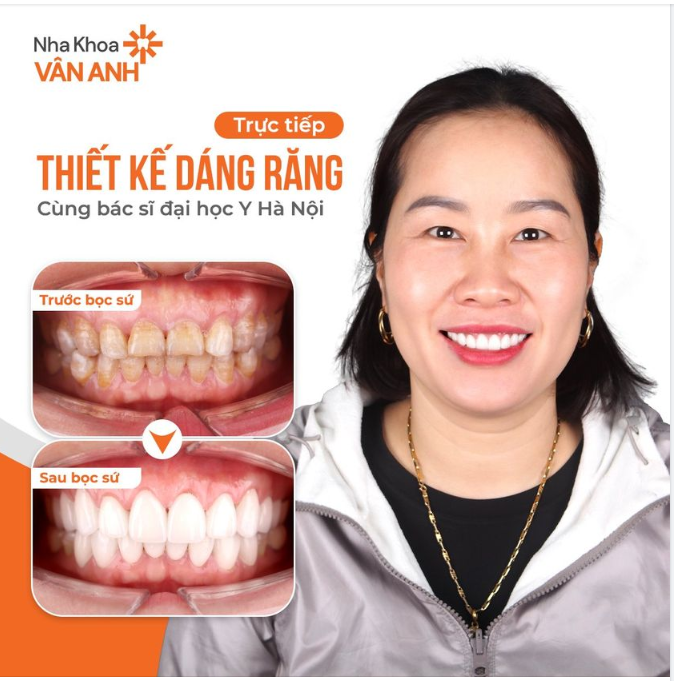 " RĂNG BỊ XỈN MÀU THẾ NÀY ĐÔI KHI CHỊ CŨNG KHÔNG TỰ TIN KHI CƯỜI "