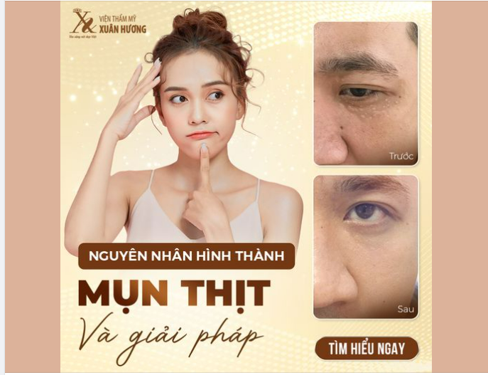 NGUYÊN NHÂN HÌNH THÀNH MỤN THỊT VÀ GIẢI PHÁP