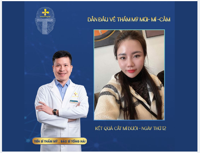 Hình ảnh khách hàng sau 12 ngày cắt mí dưới tại Thẩm mỹ Như Hoa .