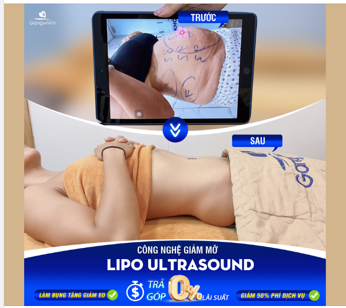 TRỢ GIÁ HÚT MỠ - LÀM ĐẸP MÙA LỄ HỘI - CƠ HỘI CHỈ CÓ 1