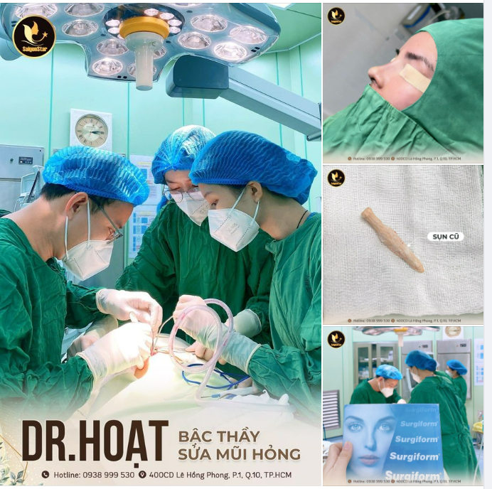 DR. HOẠT TIÊN PHONG ỨNG DỤNG SỤN SURGIFORM VÀO SỬA MŨI HỎNG