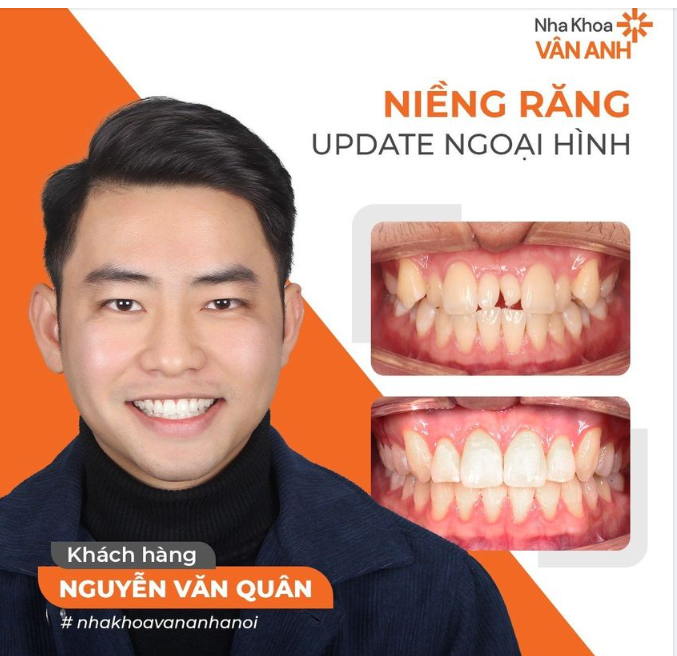 NIỀNG RĂNG NÂNG CẤP VẺ NGOÀI