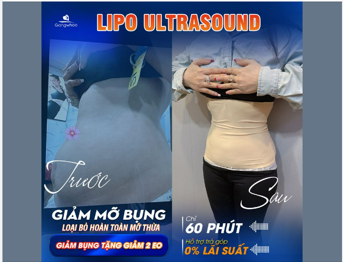 HÚT MỠ TRẢ GÓP - TƯỞNG KHÓ MÀ CÓ THẬT!
