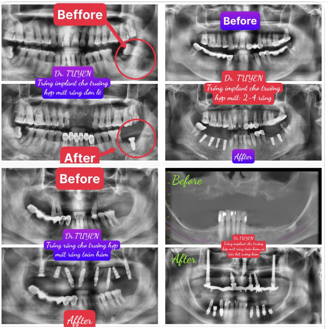 CẤY GHÉP IMPLANT CÓ THỂ ÁP DỤNG CHO MỌI TRƯỜNG HỢP MẤT RĂNG