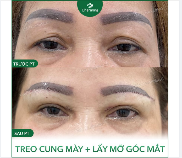 Người ta lấy mỡ full mí mắt thì có vẻ là bình thường ời.