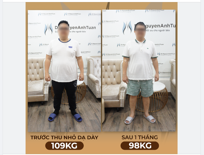 Bệnh nhân giảm 11kg an toàn và nhẹ nhàng sau 1 tháng phẫu thuật thu nhỏ dạ dày giảm cân.