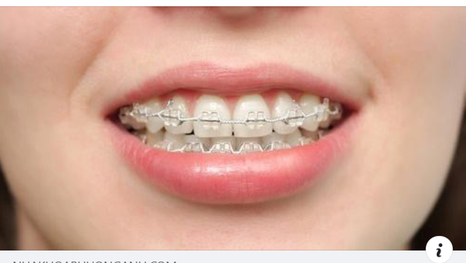 Niềng Răng Bằng Mắc Cài Sứ Có Tốt Không?