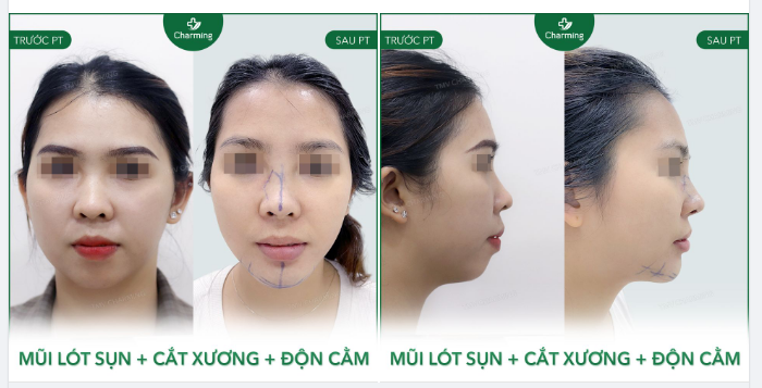  “Nâng mũi có thể thực hiện cùng lúc với độn cằm hay với phương pháp phẫu thuật nào nữa hay không?”