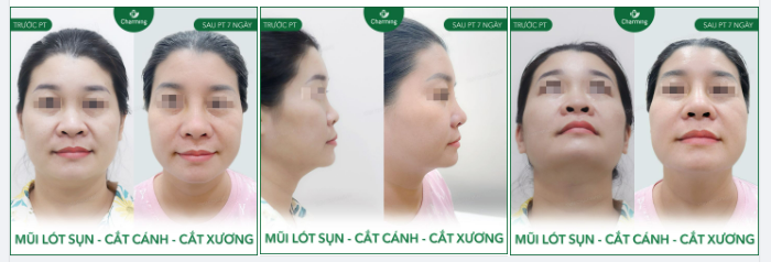 Mũi thấp nhưng xương mũi lại bè ra như hình chuông thế kia thì mình có nên đổ thừa tại mũi lo phát triển bề ngang mà quên phát triển chiều cao hông ta? .-.