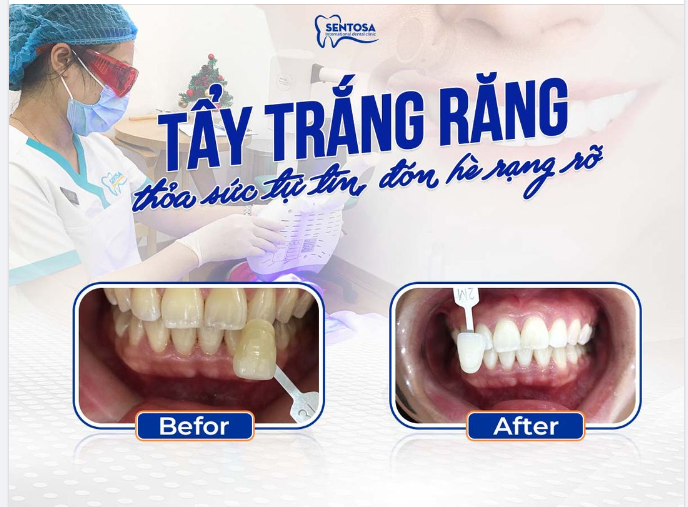 RA KHỎI SENTOSA THÌ RĂNG ĐẸP, RĂNG TRẮNG SÁNG