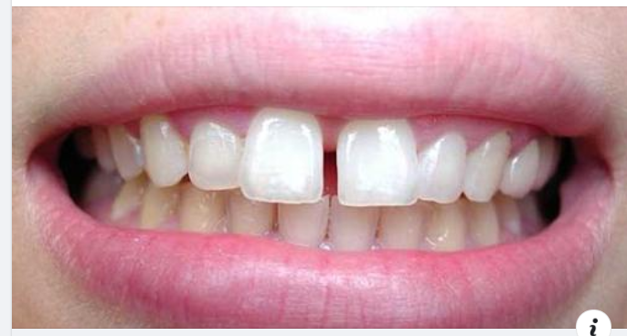 Khắc phục khe hở giữa hai răng cửa