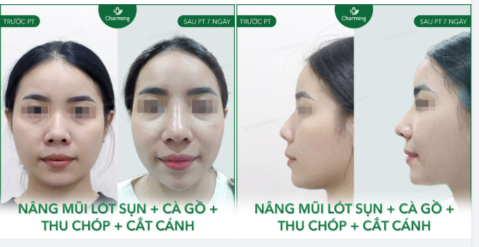 Điển hình là bạn khách này, mũi thấp, cánh mũi dày, chóp to, gồ mũi nhẹ, dùng đúng combo một lần là tẩy sách khuyết điểm mũi luôn á