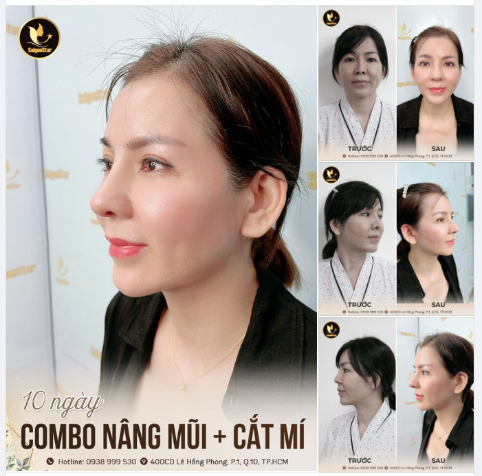 10 NGÀY THAY ĐỔI NGOẠN MỤC VỚI COMBO NÂNG MŨI KẾT HỢP CẮT MÍ